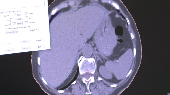 Световен ден за борба с рака: Над 1000 души са чули тежката диагноза в Северозапада